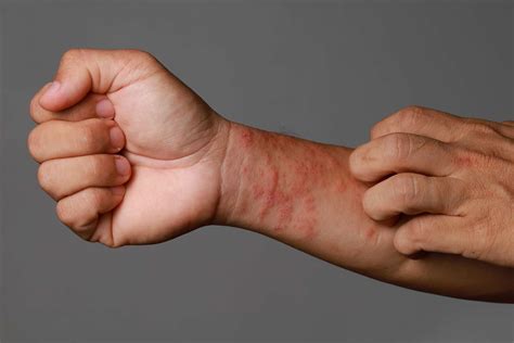 Eczema Treatment | Gentle Care, Soothing Relief | DermDox