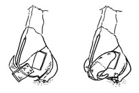 Reposition of the lower lateral cartilage with a caudal septal ...