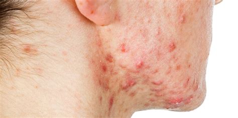 Acne/Cystic Acne | Acne Concern