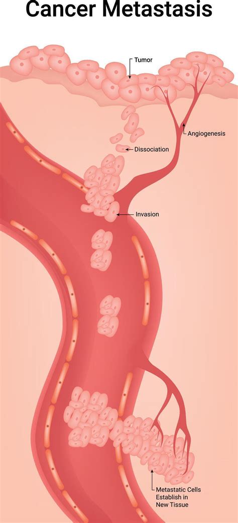 cancer metastasis science design illustration diagram  vector