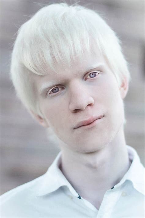 Albino Nedir? Albino Hastalığı Nedir? Nedenleri Nelerdir?-BİLGİLİ USTA
