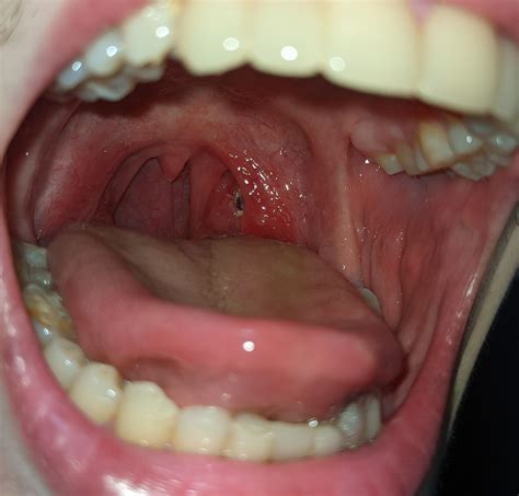 stuck popcorn kernel throat 7