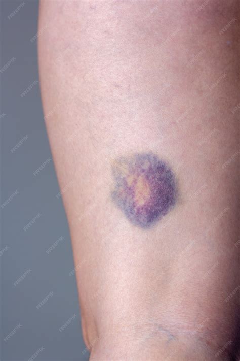 Premium Photo | Large round bruise on the leg. Damaged skin with multi