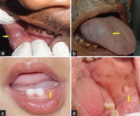 oral mucocele  clinical  histopathological study pmc