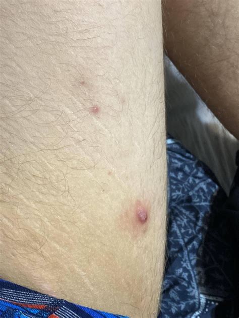 Large sore on my inner thigh, comes and goes : r/medical_advice