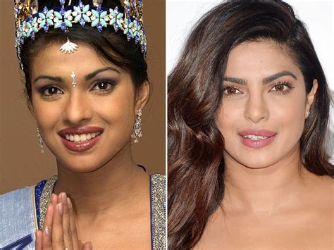 Priyanka Chopra before and after Botox Before And After, Celebrities