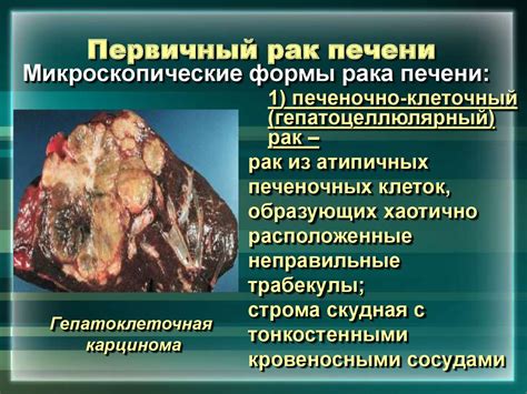 Заболевания печени - презентация онлайн