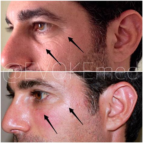 eye area evoke aesthetics