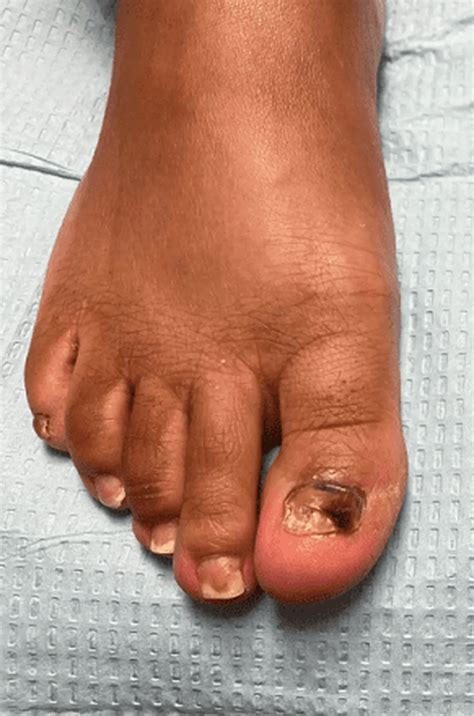 Toenail Fungus for Lincoln Park, Chicago, IL | Lincoln Park Podiatry
