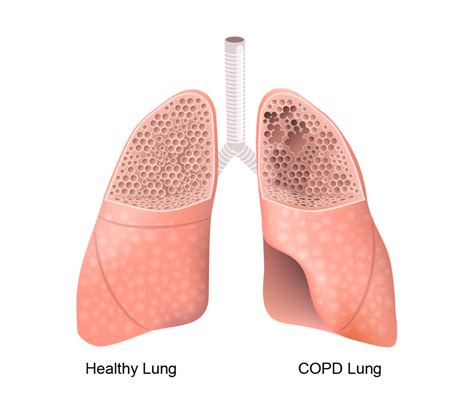 measurement copd ad medical