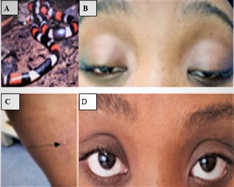 Acute myasthenic syndrome following coral snake envenomation in the ...