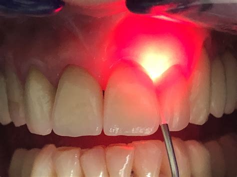 Dental Codes For Laser Treatment at Myron Moon blog