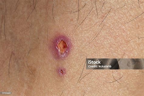 Feridas Circulares Na Pele - Foto de Infecção Da Ferida Na Pele Uma Ferida No Corpo Humano Sutura ...