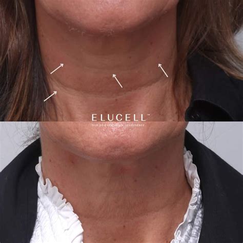 surgical neck lift treatment elucell