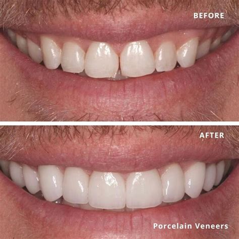 porcelain veneers       town house dental