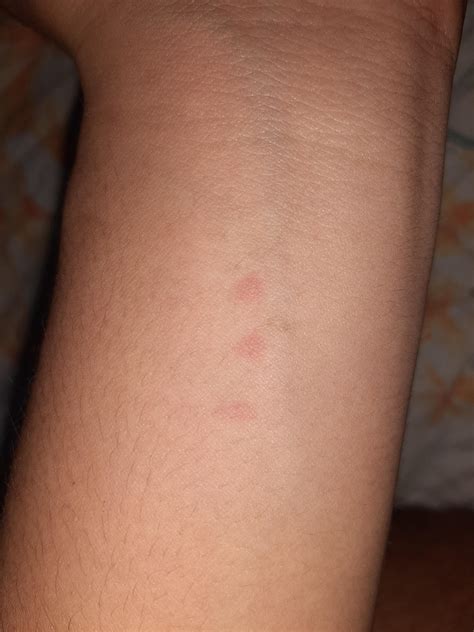 Why Do I Have A Rash With Red Dots at Rita Ellis blog