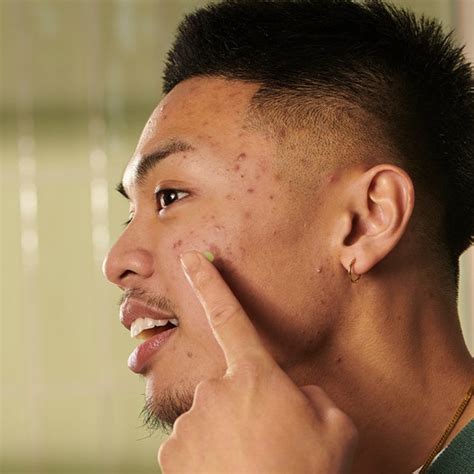 tahapan skincare  kulit berjerawat