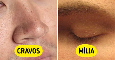 Bolinhas No Rosto Que Parecem Espinhas - 7 Bolinhas na pele que enganam e parecem espinhas comuns