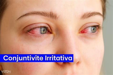 O'que E Bom Pra Conjuntivite - Conjuntivite: O que é, Sintomas, Tipos e Como Tratar