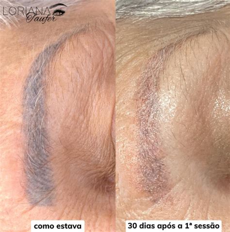 Como Fica A Sobrancelha Depois Da Despigmentação A Laser - O que é a Técnica de Despigmentação de Sobrancelhas