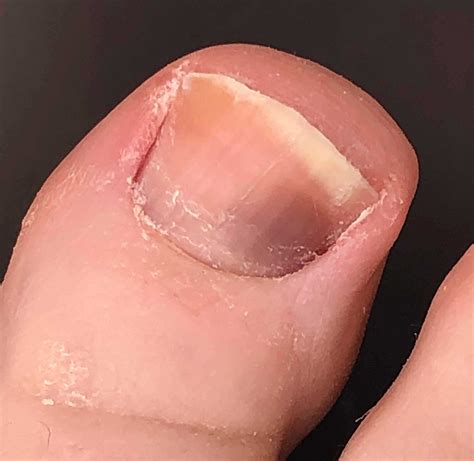 Hematoma Toenail