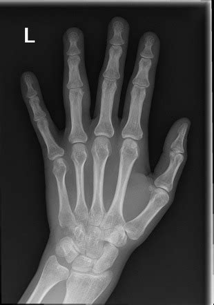 volar plate avulsion injury radiology case radiopaediaorg