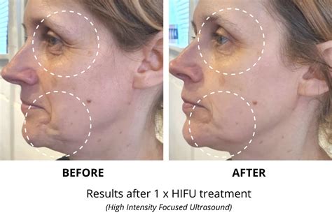 Recognizing The Dangers And Adverse Effects Of Hifu Facial Treatment