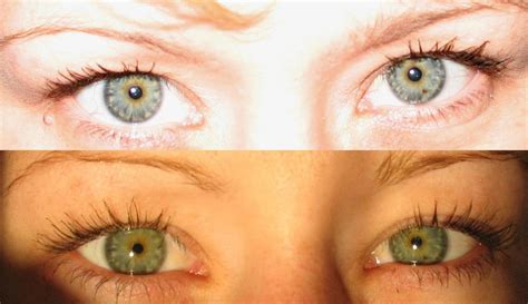 Sore eyes treatment | General center | SteadyHealth.com