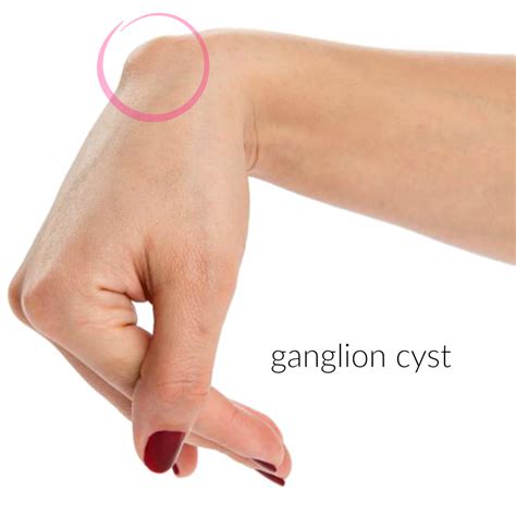 ganglion cyst   wrist         czhqm