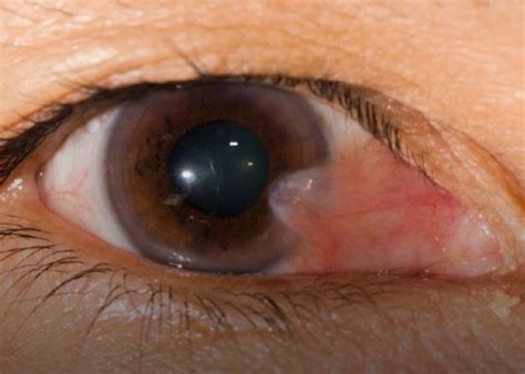 mong thit la benh gi dieu tri benh ra sao