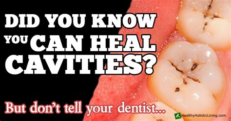 How To Heal Cavities Naturally