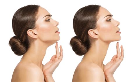 Double Chin Removal Surgery in Noida - CK Birla Hospital