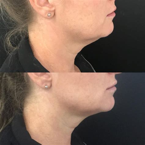 Non Surgical Face Lift For Jowls at Chantay Mccormick blog