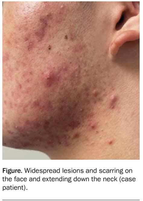 teenager  facial papules  pustules medicine today