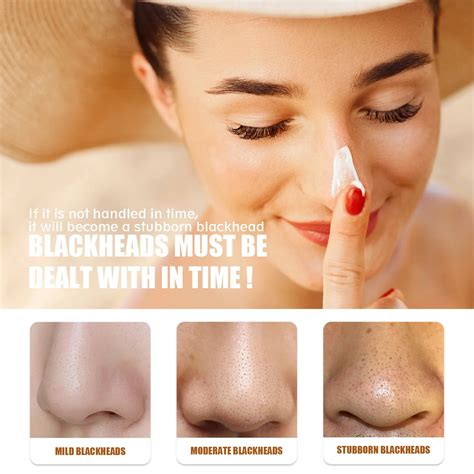 Bad Blackheads On Nose