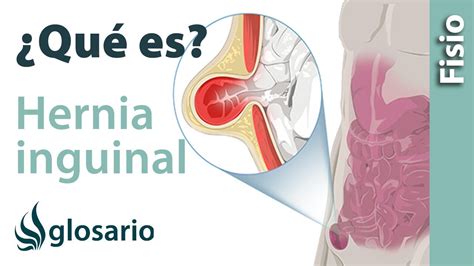 O Que Causa Hérnia Inguinal - HERNIA INGUINAL | Qué es, qué afecta, síntomas, , causas y tratamiento ...
