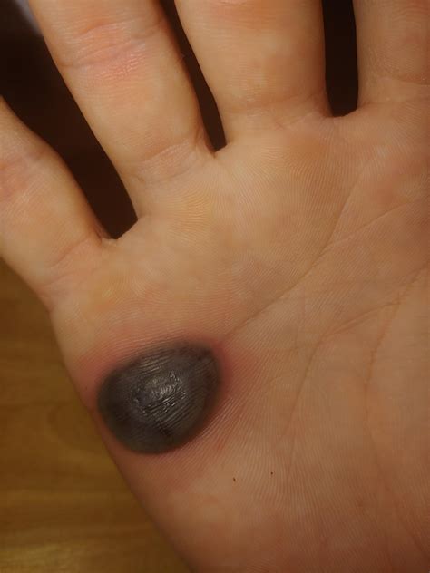 A Guide to the Freezing Stages of Wart Removal Recovery 11