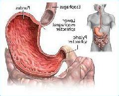 foods  avoid   peptic ulcer emasol