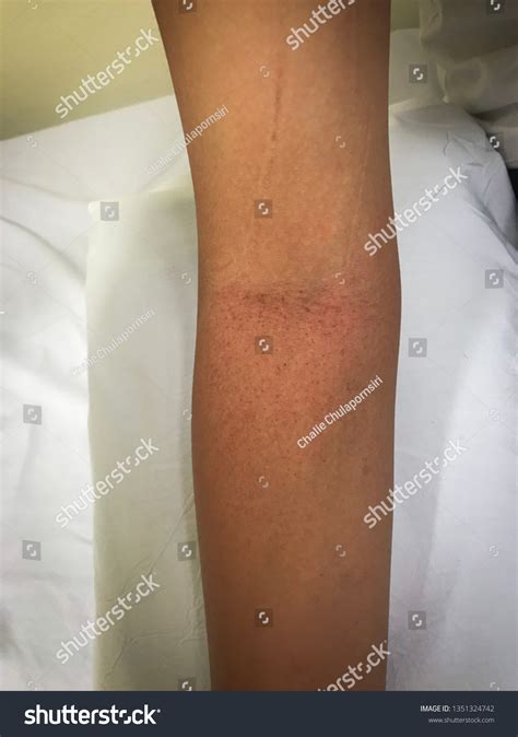 petechiae petechiae tiny purple red brown stock photo