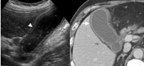 Желчный пузырь — 24Radiology.ru