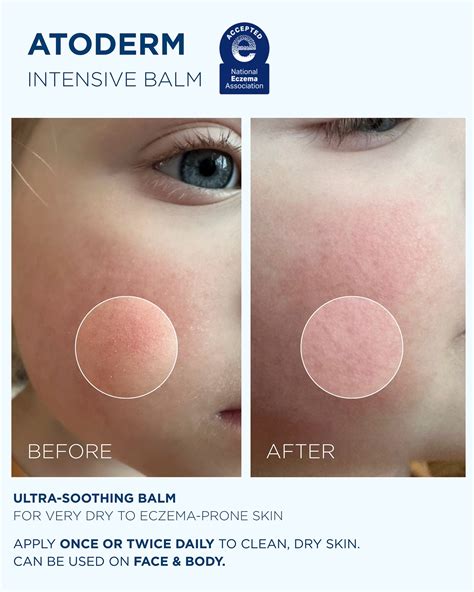 BIODERMA - It´s not just dry skin 💙 Real relief, real... | Facebook