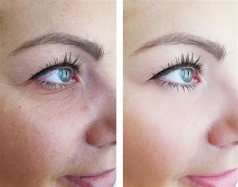 laser eye wrinkle treatment