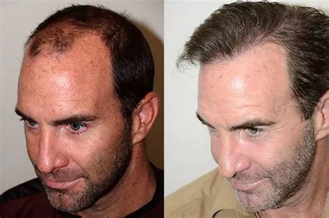 mens hair transplant cost     hairhealthtipscom