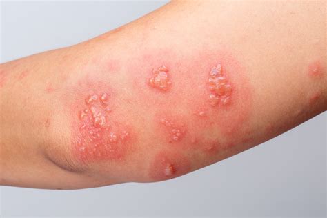 Herpes No Corpo E Contagioso