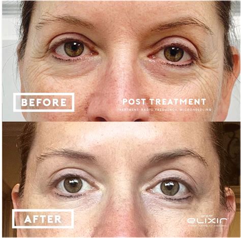 exosomes  skin anna avaliani md cosmetic laser surgery anna