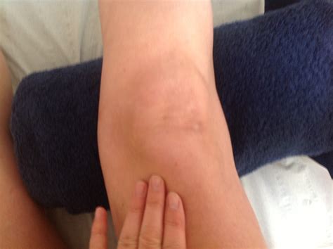 Vastus Medialis Pain