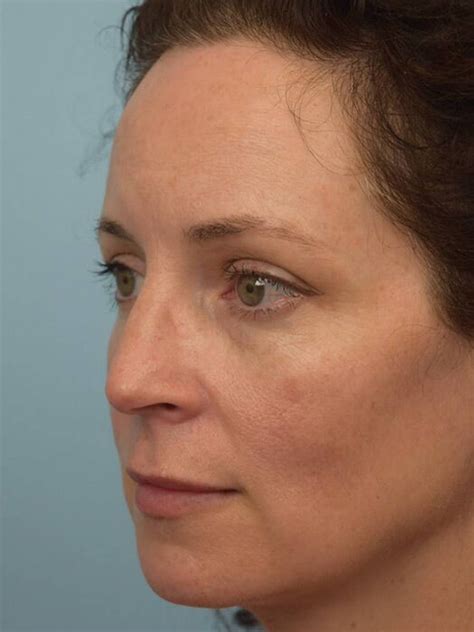 Before & After Skin Care | Houston, TX | Face Forward