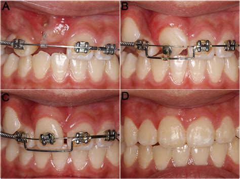 Intraoral photographs during treatment. | Download Scientific Diagram