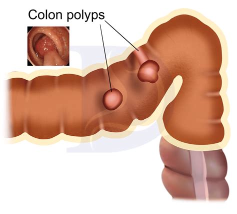 Rectal Polyp Symptoms