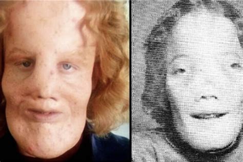 The incredible life of Rocky Dennis - the boy whose rare deformity ...